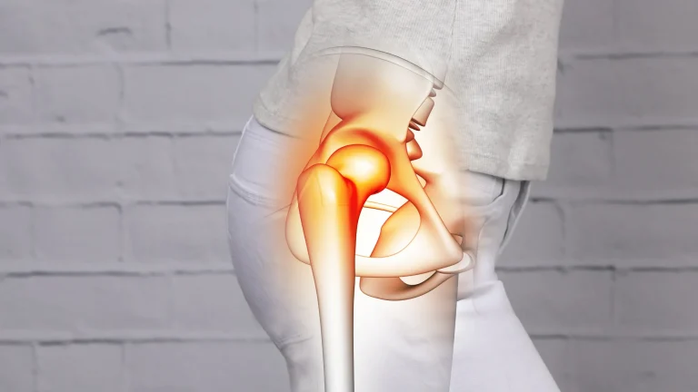 arthrose hanche