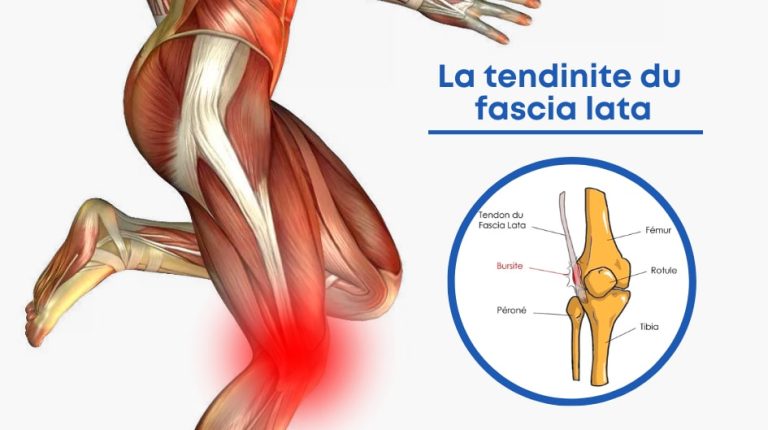 Pourquoi le muscle tenseur du fascia lata peut il être douloureux