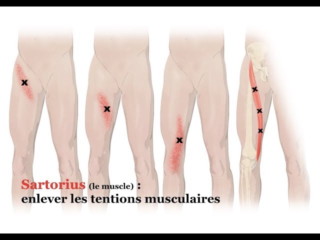 Quelles sont les causes et solutions à la douleur du muscle sartorius